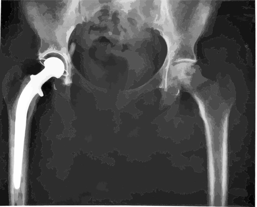 Hip replacement Image 3684-PH png transparent